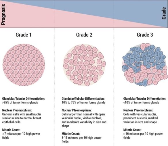 breast-cancer-grades-illustration